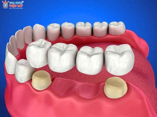 Các dịch vụ làm răng phổ biến