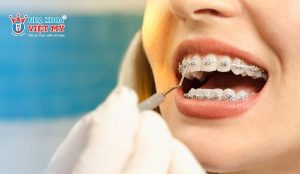 Các dịch vụ làm răng phổ biến